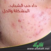 داء حب الشباب.. المشكلة والحل