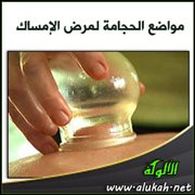 مواضع الحجامة لمرض الإمساك