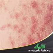 الحمى التيفية ونظيرتها